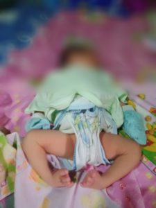 Bayi Kaki Bengkok Warga Waylayap Pesawaran Perlu Penanganan Intensif Medis